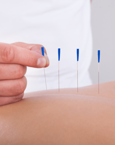 Akupunktur, vücudun işlevlerini iyileştirir ve belirli anatomik bölgelerdeki özel noktaları uyararak doğal yönden kendi kendini iyileştirme sürecini destekler. 